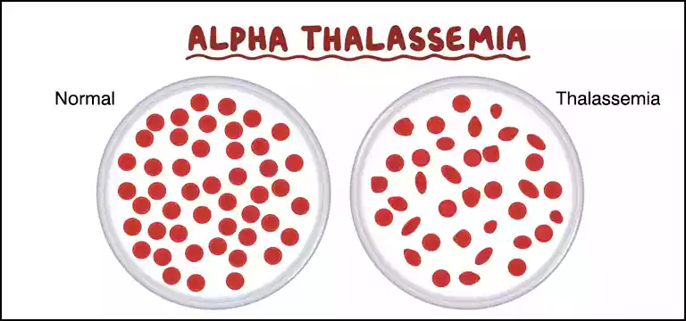 Alpha Thalassemia: Types, Diagnosis & Price